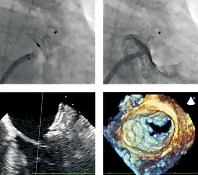 A. Tzikas et al A B C D MV Figure 3. Multimodality imaging of the LAA after implantation of the Amplatzer Amulet device. The Amplatzer Amulet in its final position (panel A) on angiography.