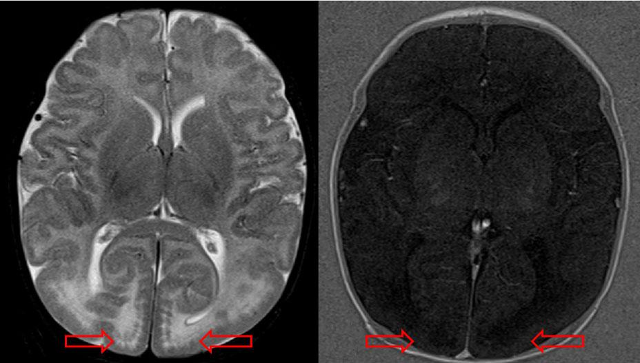 174 Young-Mi Han, et al. A Case of MDCMD with Cortical Abnormalities under classic CMD. MDCMD is a rare disease, especially in non-caucasians 4).