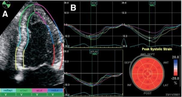 At echocardiography: LVEF might be normal Advanced echo (GLS): impaired LV longitudinal function Dilated left atrium and inferior