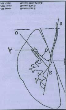 ! Measurement of lower pole anatomy: infundibular length: A B infundibular