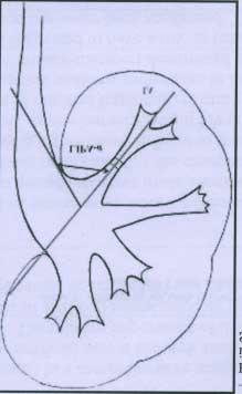 ! Lower infundibulopelvic angle was drawn between central axis of lower pole