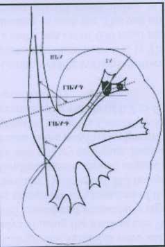 ! Lower infundibulopelvic angle was determined as angle between central axis of lower infundibulum (not axis of stone bearing calix) ) and renal