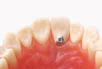 Insert the abutment into the implant and tighten the basal screw to a