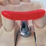 Insert the abutment into the implant and tighten the basal screw to a