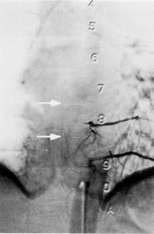 83 Case Report: Conti et al: Anterior Spinal Artery Syndrome A B Fig 2.