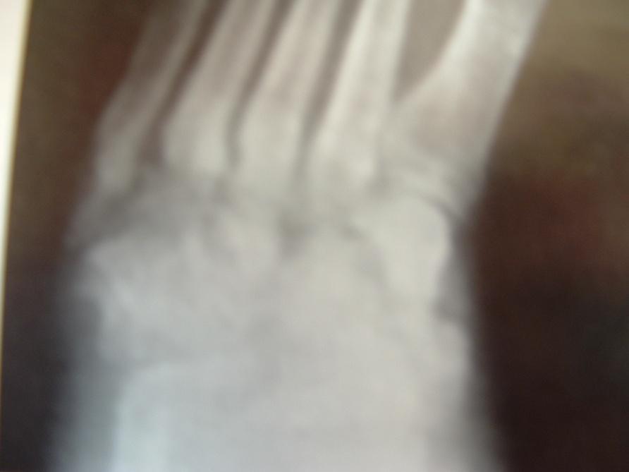Imaging in the diagnosis of Charcot osteoarthropathy During stage 1, if x-rays are negative, serial