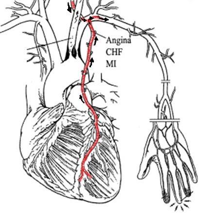 CORONARY-SUBCLAVIAN STEAL Often in coronary artery bypass graft surgeries, the internal thoracic artery (formerly called the internal mammary artery) is surgically anastomosed to the coronary