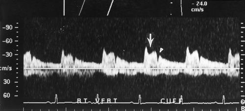 Recall that spectral Doppler ultrasounds plot velocity versus time.