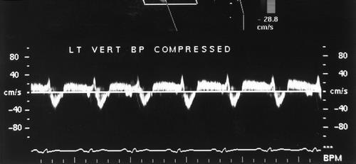 COMPANION PATIENT #5: TYPE 4 V A WAVEFORM As even greater stenosis causes a greater pressure differential, flow transiently reverses in the vertebral artery.