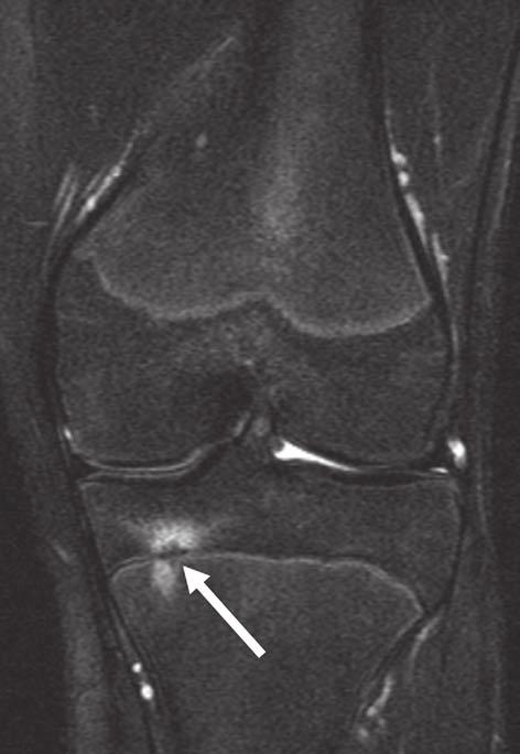 MRI of the Adolescent Knee version time, 150 ms; ETL, 10; matrix, 256 160; slice thickness, 5 mm), or a coronal fat-suppressed FSE intermediate-weighted sequence (1.