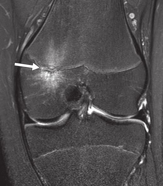 MRI of the Adolescent Knee Fig. 2 13-year-old male athlete who participates in several sports presented with 2-month history of left knee pain.