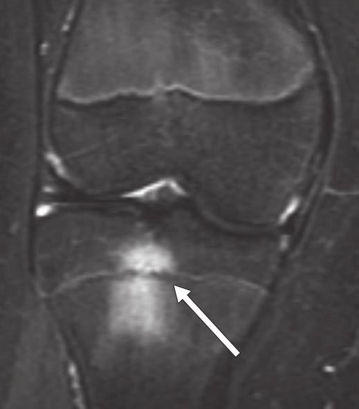 Similar zone was seen also in proximal fibula (not shown). No other abnormality of knee to account for patient s pain was identified at MRI evaluation.