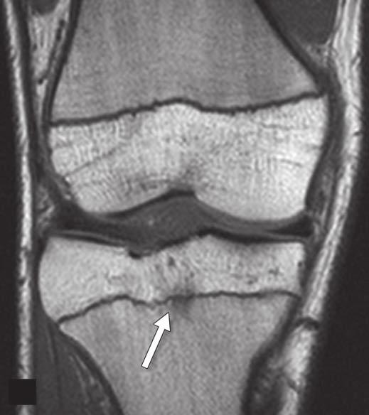 epiphysis centered about proximal tibial physis. This patient also had nondisplaced medial meniscal tear and posterolateral marrow edema pattern (not shown).
