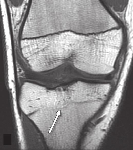 Bridging trabecular bone (arrow) is now seen across area of physis previously involved with FOPE zone.