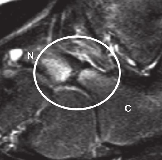 Zbojniewicz and Laor Fig. 7 9-year-old male athlete with right subtalar foot pain.
