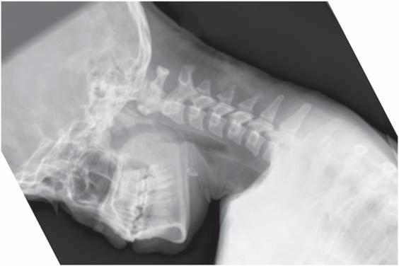 702 Rihn et al. R FLEXION Fig. 2. A flexion lateral cervical radiograph demonstrating the mechanism of cervical injury that occurs with spear tackling.