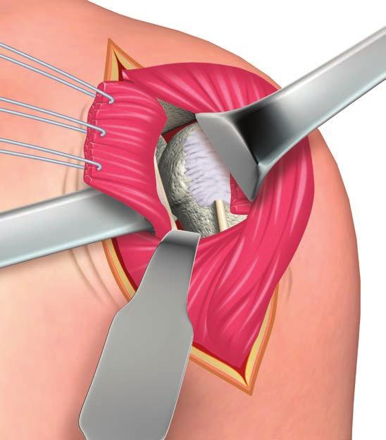 Operative technique ReUnion TSA Shoulder System Surgical technique Subscapularis tendon release (capsulotomy) Prior to performing the anterior capsulotomy for exposure, the surgeon should determine