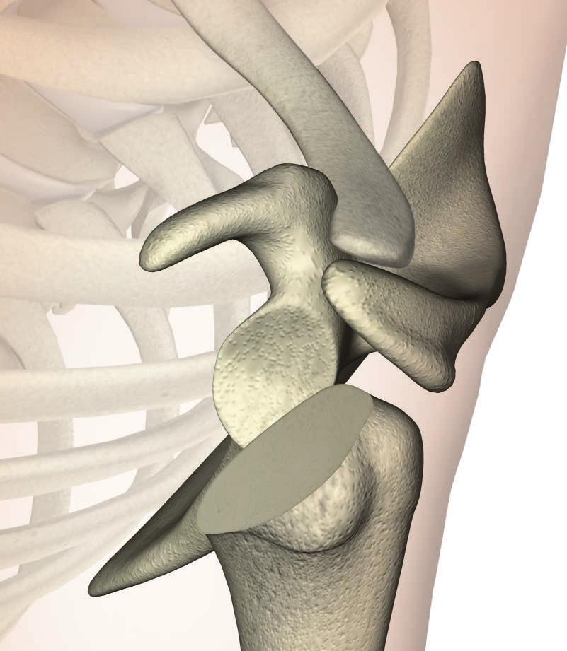 ReUnion TSA Shoulder System Operative technique Glenoid surface preparation Pre-operative planning and glenoid exposure There is a wide variation of glenoid bone pathoanatomy.