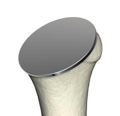 of the glenoid, the ReUnion TSA Humeral Retractor should be