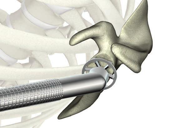 The objective is to provide a uniform contour at the desired angle of version to achieve uniform contact for the glenoid trials and implant.