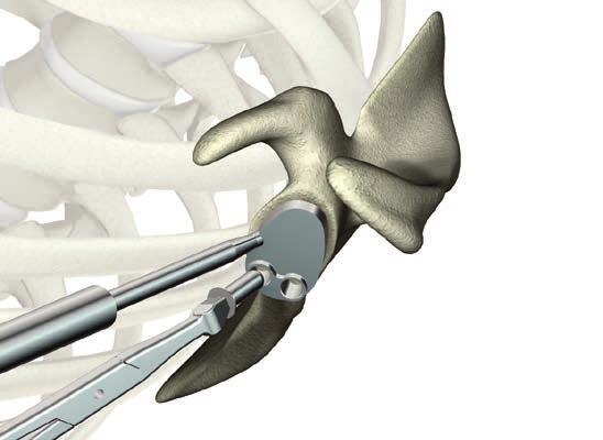 Pegged glenoid preparation Operative technique ReUnion TSA Shoulder System Take the variable angle glenoid drill and drill the anterior-inferior hole until the drill bit is completely engaged and the