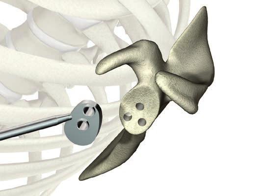 ReUnion TSA Shoulder System Operative technique Pegged glenoid preparation Take the variable angle glenoid drill and drill the posterior-inferior hole until the drill bit is completely seated within