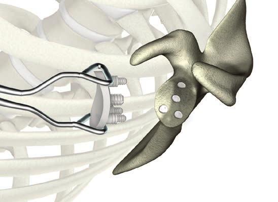 ReUnion TSA Shoulder System Operative technique Pegged glenoid preparation The implant pegs are centered over the respective peg holes.