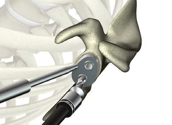 Keeled glenoid preparation Operative technique ReUnion TSA Shoulder System Take the variable angle glenoid drill and drill the inferior hole until the drill bit is fully engaged and the drill bit s