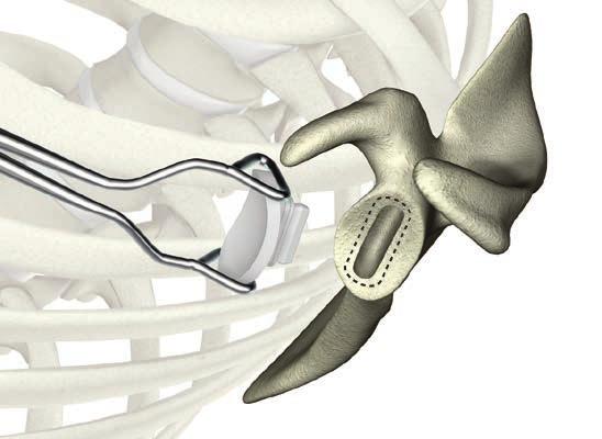 Keeled glenoid preparation Operative technique ReUnion TSA Shoulder System Fully cemented SP keel If presented with poor bone quality in the central region of the glenoid, the larger diameter area of