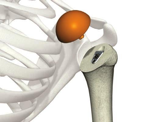 ReUnion TSA Shoulder System Operative technique Humeral head trialing With the proper modular head in place, it should be possible to achieve proper tensioning of the rotator cuff tendons, have a