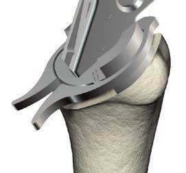 Figure 115 An optional fixed height adapter may be used to ensure a proper seating level of the humeral stem into the cement.