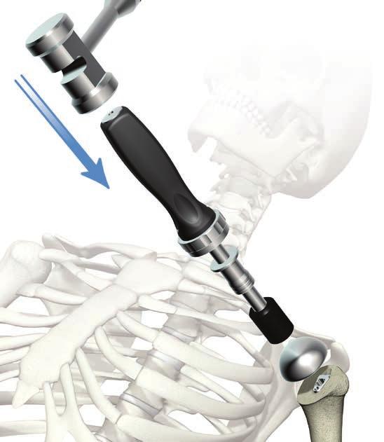 Operative technique ReUnion TSA Shoulder System Final implant insertion Select the correct sized head as previously trialed and place the humeral head on the humeral stem.