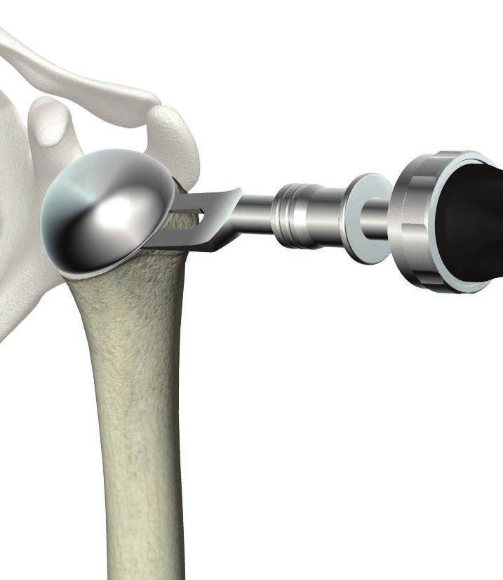 Operative technique ReUnion TSA Shoulder System Implant removal Humeral head removal Attach the forked removal tool to the 4-sided ratcheting handle and slide the forked humeral head removal tool