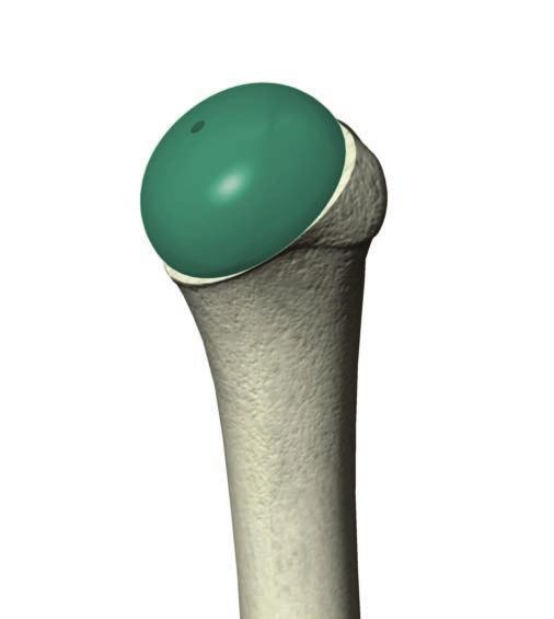 When a glenoid is used, this lateralizes the joint line so the humeral head thickness will be 4mm less than the resected head.