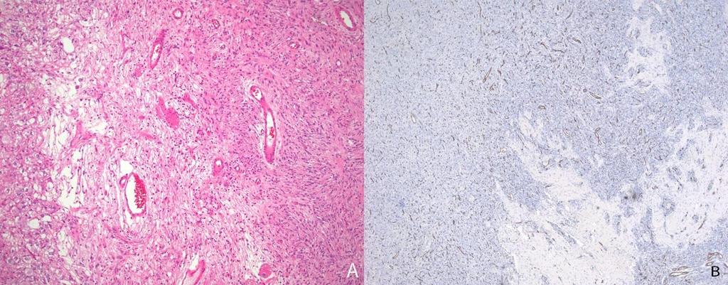 Cortical surface of tumor showing the superficial location of the tumor as well as tumor growth into the leptomeninges.