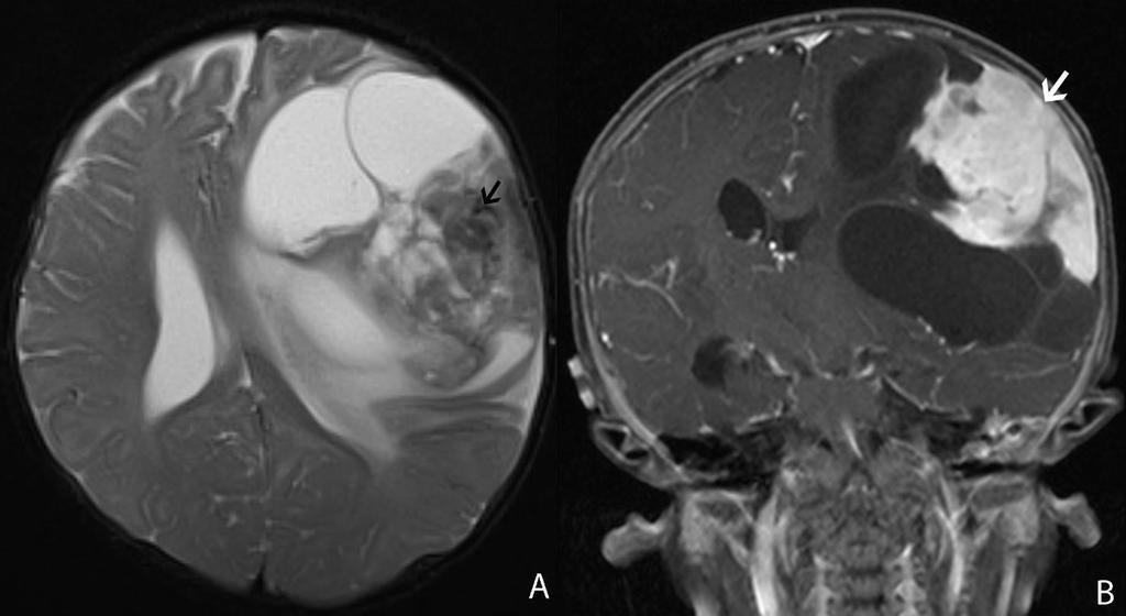 Figure 5: 6 month-old male infant with increasing head circumference and pathology proven DIG A) Findings: There is a large heterogeneous tumor with peripheral heterogeneous solid component with a