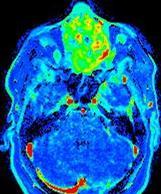 malignant Prediction of outcome MRI scans before therapy and 2 weeks into