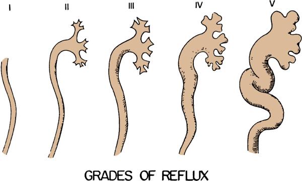 International classification of VUR (Campbell s 9 th edition) Description I Into a nondilated ureter Figure 117-2 II III I V V Into the pelvis and calyces without dilatation Mild to moderate
