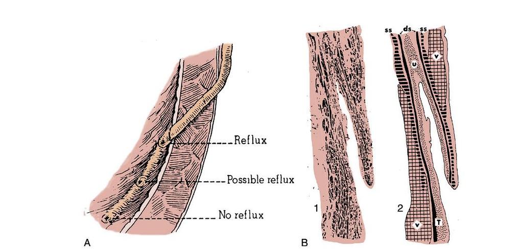 Vesicoureteral reflux (VUR) refers to the retrograde flow of urine from the bladder into the ureter.