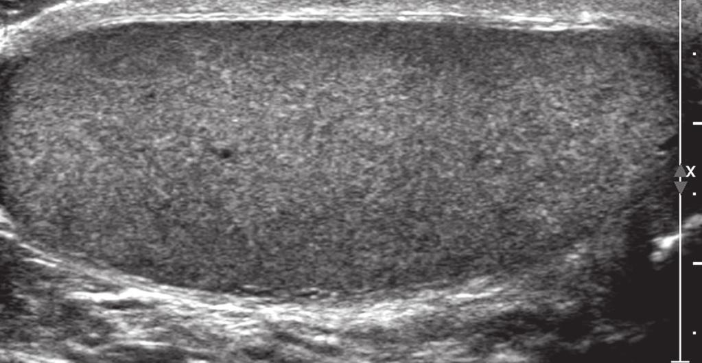 and C, Sagittal sonograms show both testes to be located in the inguinal canals and diminutive.
