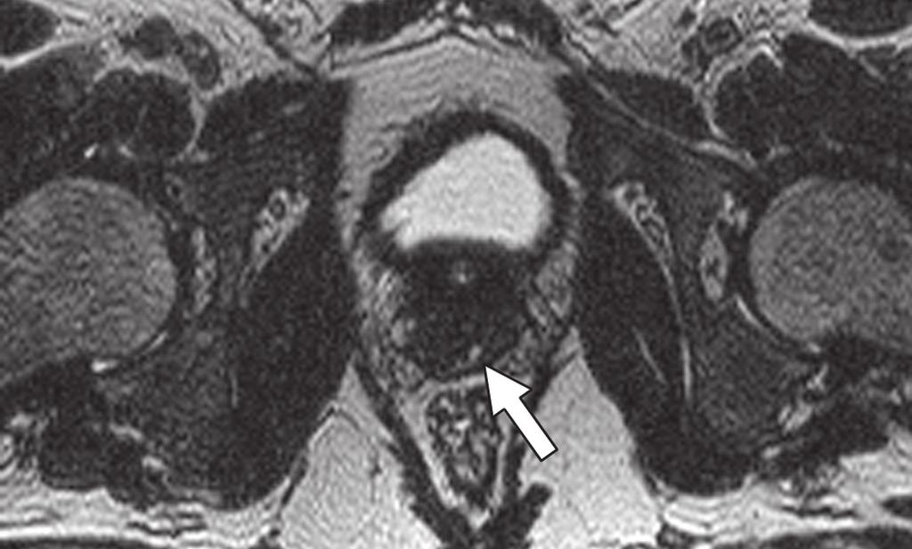 normal ejaculatory ducts entering the prostate gland (arrows).