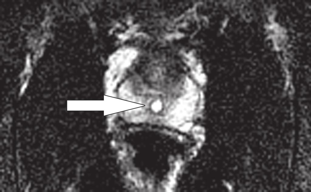 midline cyst (arrow) limited to the prostate gland.