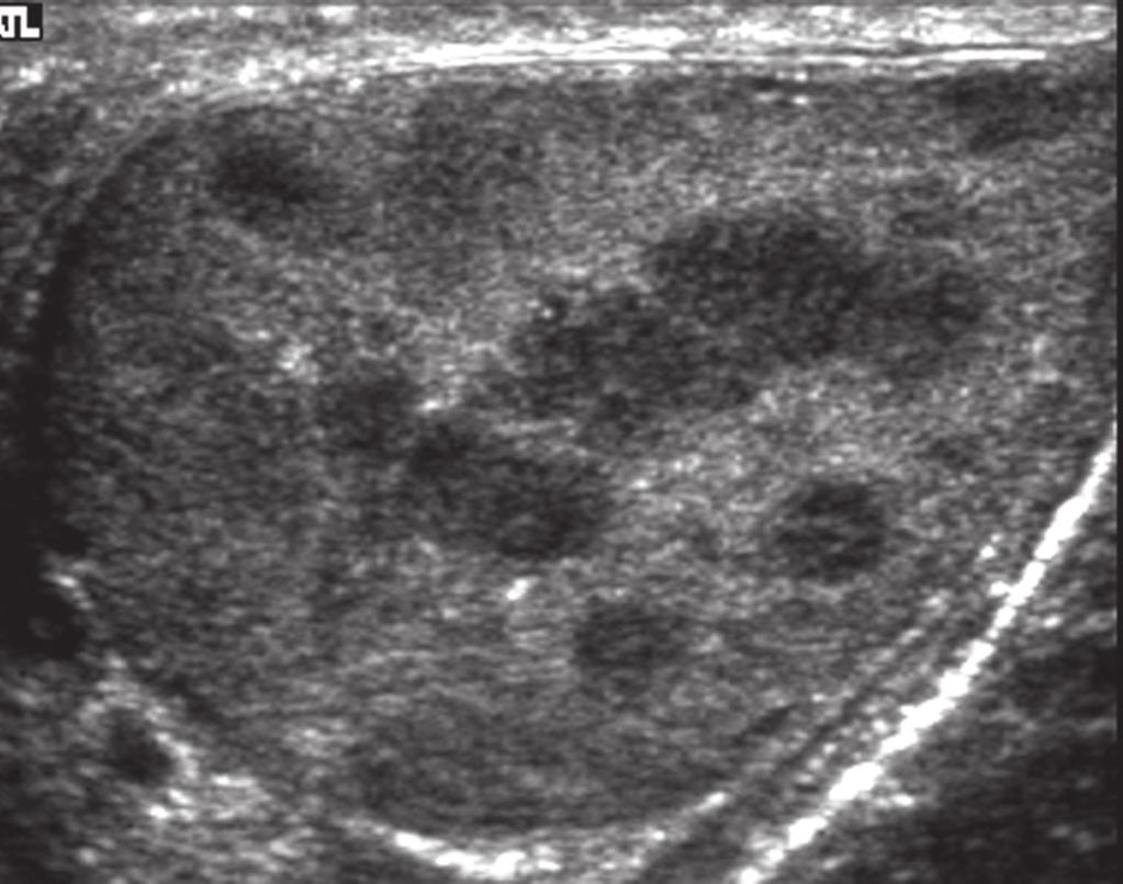 Simpson and Rausch Fig. 9 33-year-old asymptomatic, hypospermic man undergoing infertility evaluation.