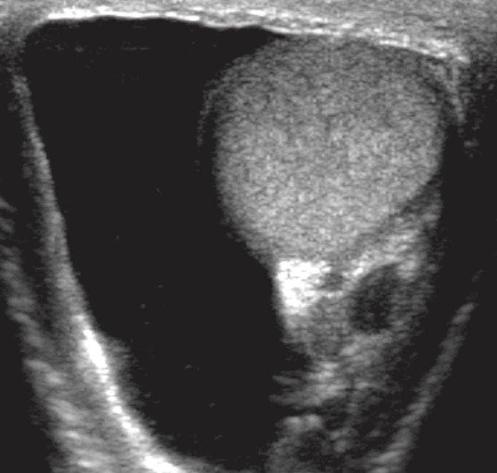 11 Longitudinal sonogram of a testicle of a 25-year-old man undergoing scrotal sonography as part of an infertility evaluation shows multiple punctate calcifications scattered throughout the