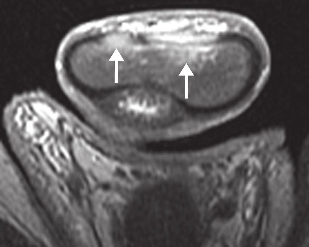 Collins JI, Woodward PJ. Radiological evaluation of infertility. Semin Ultrasound CT MR 1995; 16:304 316 4. rugh VM, Matschke HM, Lipshultz LI. Male factor infertility.