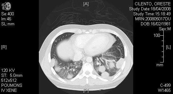 Clinical case A 23 year-old patient has consulted for dyspnea and haemoptysia.