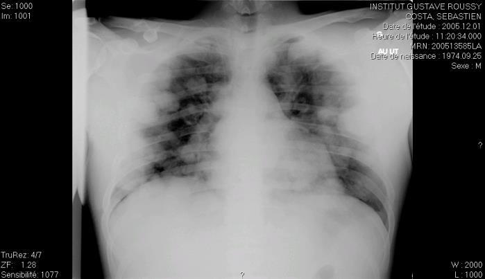 Extensive lung mets Dyspnea or po2<80 1997-2006 3/10 (30%) Total