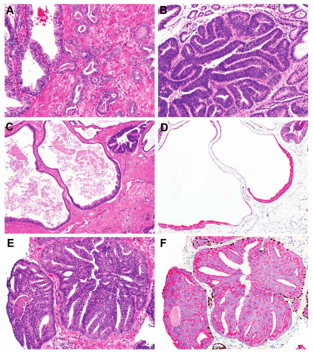 Figure 3. Malignant mimics of high-grade prostatic intraepithelial neoplasia (HGPIN).