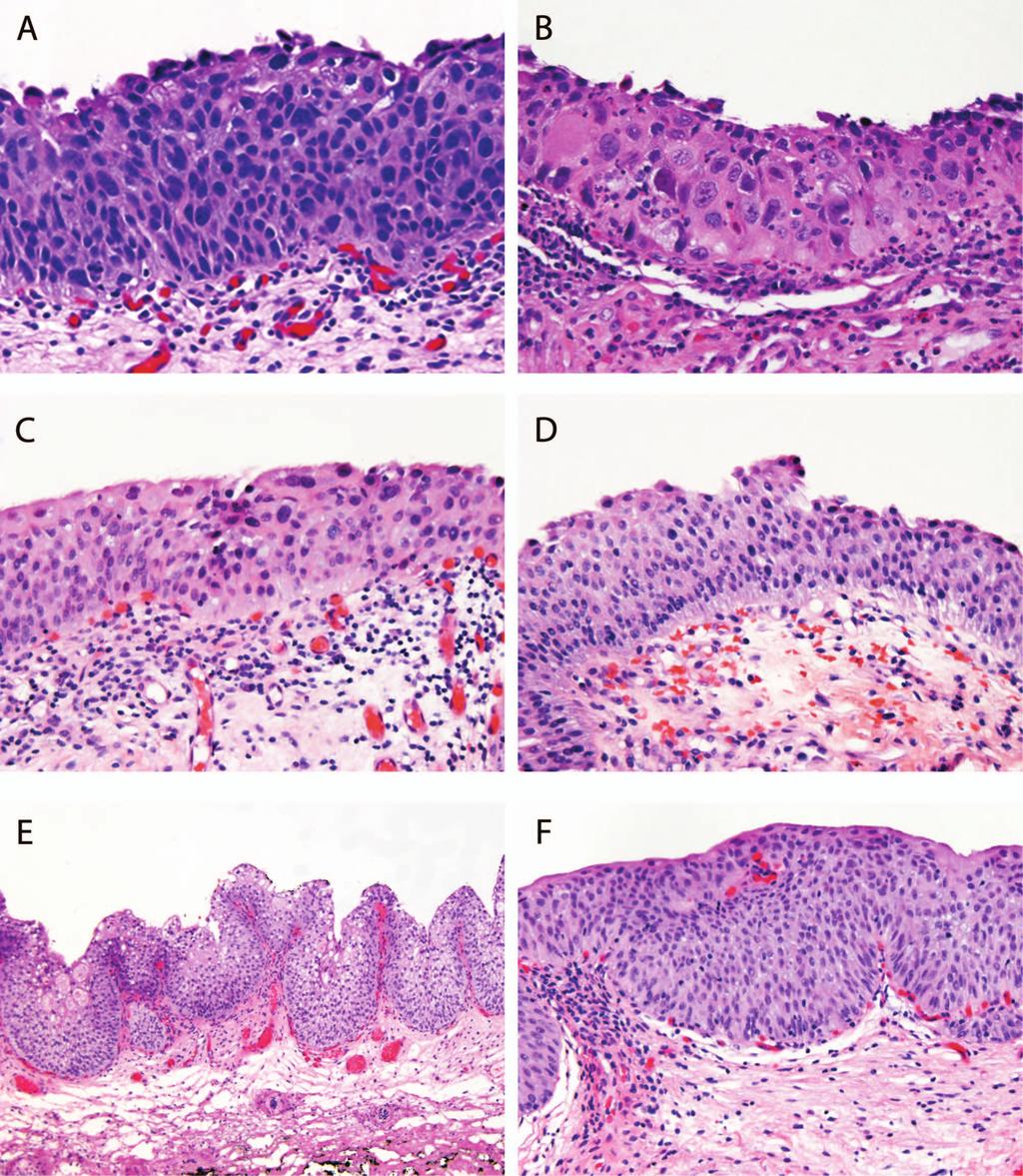 Figure 4. Precursor lesions of urothelial carcinoma. Urothelial carcinoma in situ exhibiting marked nuclear pleomorphism, hyperchromasia, and disorganization (A, B).