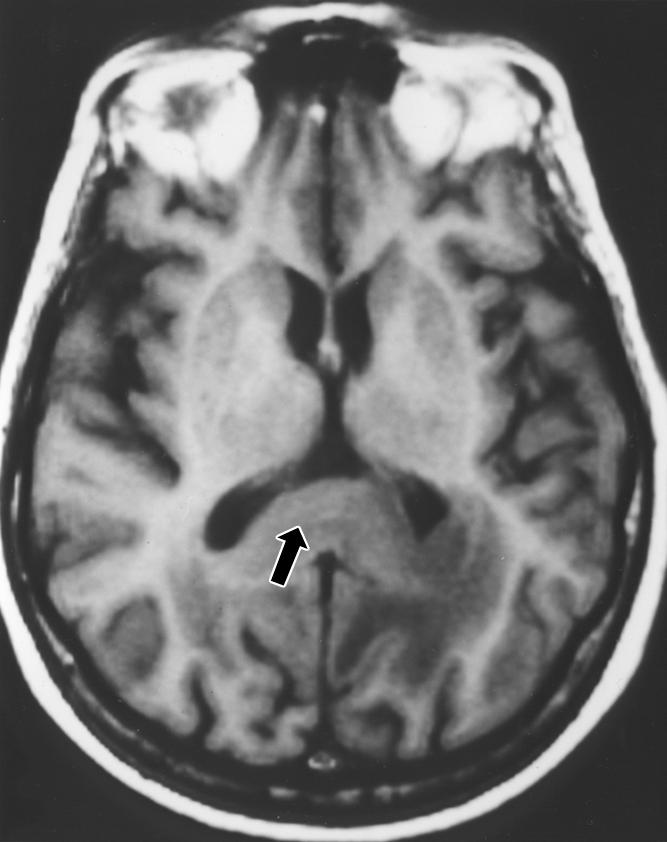 , xial T2-weighted MR image shows hyperintensity (arrow) in left parietal white matter extending across corpus callosum with mass effect on lateral ventricle.